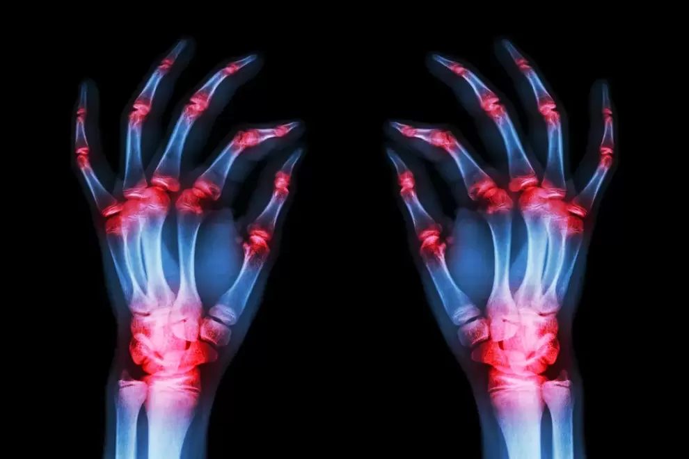sõrmede liigeste artroos