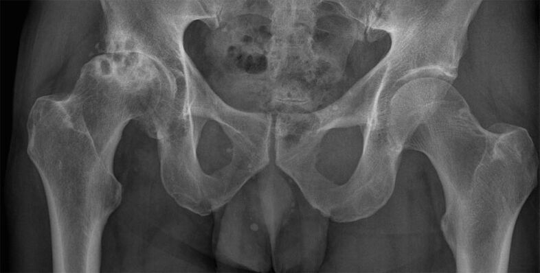 Puusaliigese artroos 3. staadium röntgenis