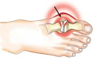Pöidla ja jala vahelise liigesepõletik artriidi korral