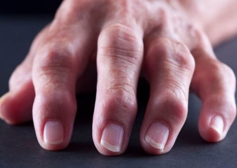reumatoidartriit kui valu põhjus sõrmede liigestes